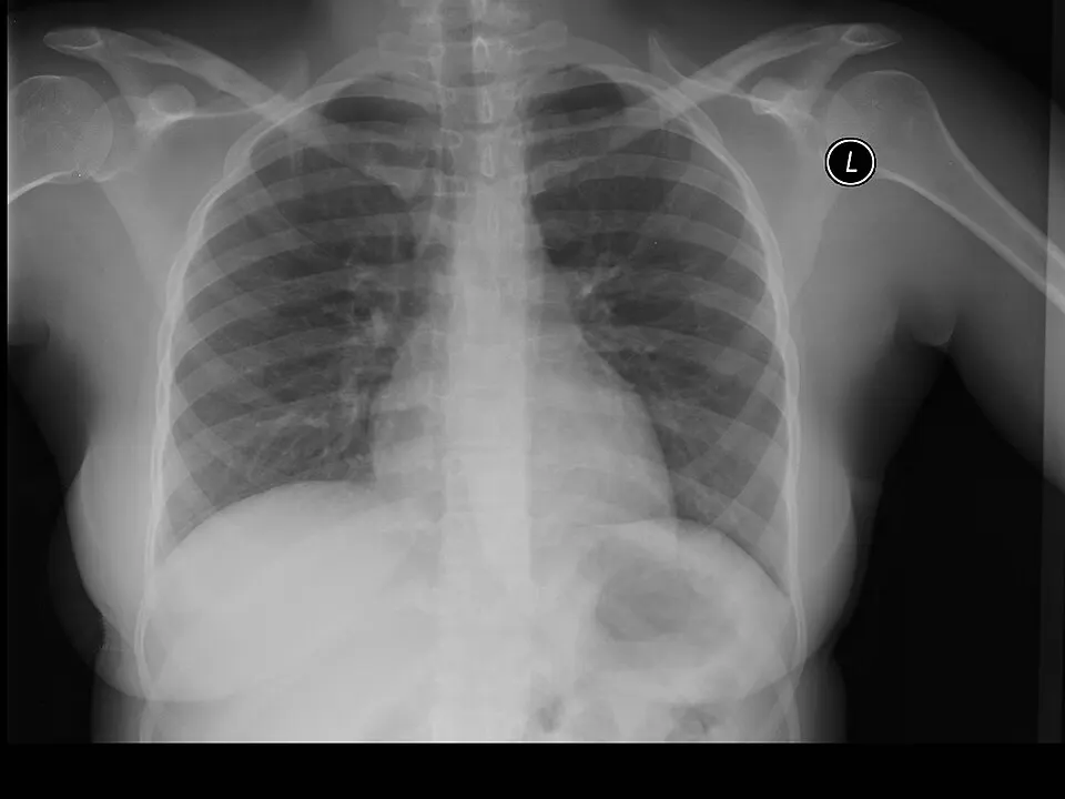 A black-and-white X-ray of a human chest showing ribs, shoulders and two dark lung areas.